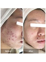 モカ 天王寺店(MOKA)/剥離3回 ハーブ　毛穴ケア　跡