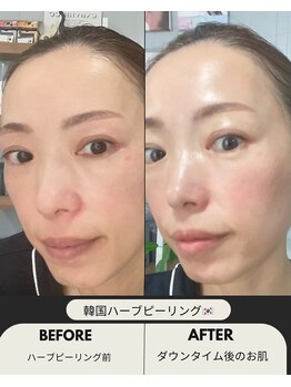 コンフィ(Comfy)/韓国ハーブピーリング