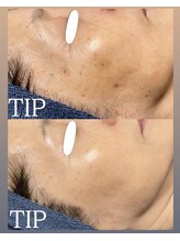 ムーンリズム(Moonlism)/【TIPハーブ症例】シミ