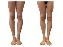 ベンザイ 梅田店(BENZAI)/O脚、骨盤のずれ