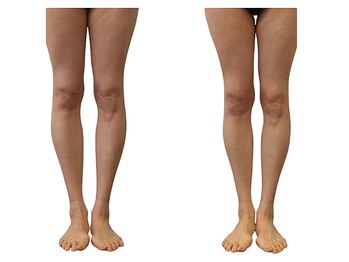 ベンザイ 梅田店(BENZAI)/O脚、骨盤のずれ