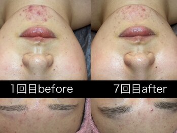 リボーン(Reborn)/繰り返すニキビに根本からケア