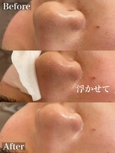 ラナ(Lana)/3D毛穴洗浄