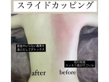 血流を促し、コリを流し体引き締め・軽くなるスライドカッピング