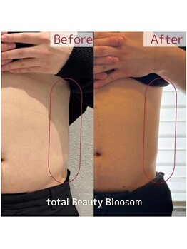 Blossom 【ホワイトニング/脱毛/韓国肌管理/毛穴洗浄】【3/23 NEW OPEN(予定)】/REDSHOT　お腹