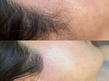 ゴールデンエイジ 吉祥寺(GOLDEN AGE)/ワックス脱毛 : 施術