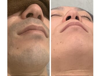 ケイ(Kei)の写真/ひげ脱毛で清潔感アップ!初回¥980★痛みが少ない&最短で高効果を出す最新マシン導入☆