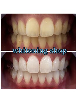 ホワイトニングショップ 南堀江店/セルフホワイトニング[南堀江]