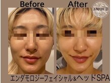 アムール 麻布十番(Amour)/エンダモフェイシャル☆集中ケア