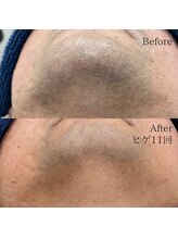 シャレールオム(Chareir Homme)/ヒゲ脱毛11回のビフォーアフター
