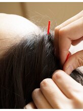 美麗鍼灸院/頭皮鍼♪美容鍼とセットでどうぞ