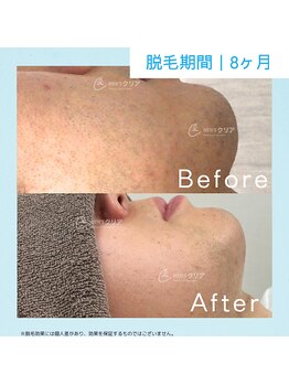 メンズクリア いわき店/【メンズクリア】お客様の施術例