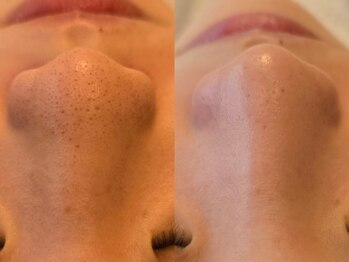 サロンドフララ 表参道店(Salon de Fulala)/毛穴洗浄/角栓除去/黒ずみ/吸引