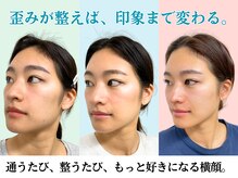 ナチュラルビューティーフェイス 横浜(NBF)/エラ張り・フェイスライン矯正