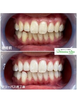 ホワイトニングサロン 名古屋駅店/【ホワイトニング施術例】
