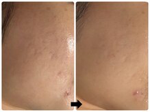 エフェクト 塚口店(effect)/Before After &nbsp;&nbsp;20代/2回目