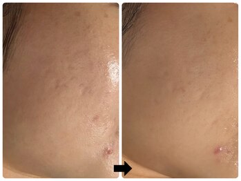 エフェクト 塚口店(effect)/Before After 20代/2回目