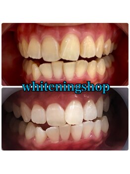 ホワイトニングショップ 池田店/【BEFORE/AFTER】