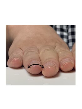 シープラス/爪のアーチ