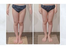 ガーレット(Garlett)の雰囲気（（筋膜ケア×ラジオ派・吸引×リンパ）ウルトラコース6回の変化）