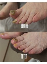 おん/自分で切れない足の爪