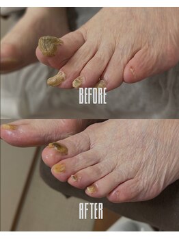 おん/自分で切れない足の爪