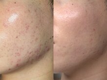 プレナ(PLENA)/【ニキビや赤み改善】