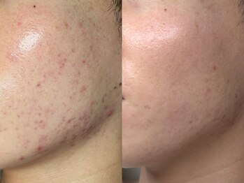 プレナ(PLENA)/【ニキビや赤み改善】