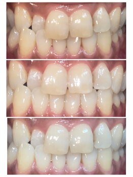 グリンプラス(grin+)/ナチュラルに白く