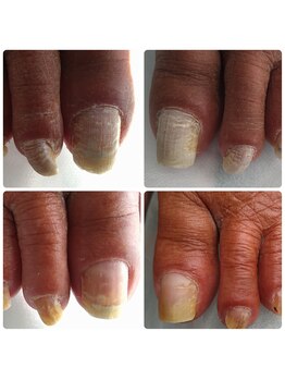 あし処 トコトコ(tocotoco)/肥厚爪