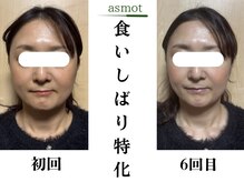 asmot鍼灸 整体院 代々木上原(asmot鍼灸 整体院)/たるみ・疲れ顔を改善