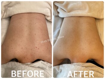 ハーブピーリング 恵比寿/背中ニキビ/引締め