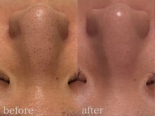 サラ 恵比寿店(SARA)の雰囲気（毛穴洗浄×フォトRF/before after）