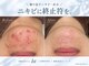 ファースト(1st)の写真