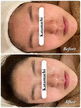 メナードフェイシャルサロン 片町店/新発売！最新ラインズLRパック