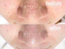 メモリ/お客様の変化/毛穴ケア