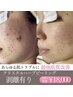 《最強★肌質改善》クリスタルハーブピーリング(お顔)モニター価格¥18,000