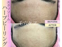 Cスキンケアクリニック 麻布店/ハーブピーリングBeforeAfter