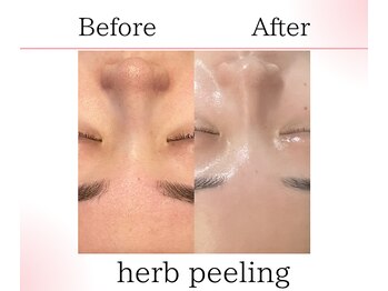 サロンツキ(salon tuki)/ハーブピーリング症例★徳島