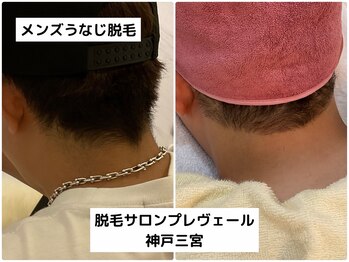 プレヴェール 神戸三宮/メンズうなじ脱毛