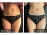 【脂肪燃焼】女性ラジオ波＋キャビ＋ハンドリンパトリートメント75分7000円