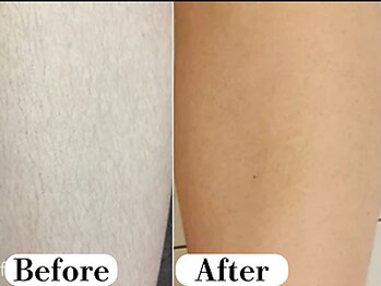 ビースキン 広島(BE:SKIN)/脚/全身脱毛/フェイシャル/VIO