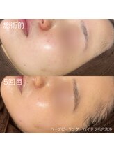 ルルラ リコ(lulula rico)/症例写真/ハーブピーリング