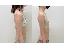 ワイサロン(Y salon)/バストアップ/4ヶ月/B→Dカップ