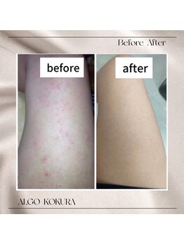 アルゴ 小倉守恒店(ALGO)/脱毛しながら美肌へ!!