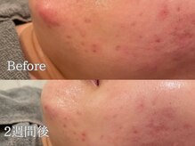 ポポラス(POPOLUS)/ニキビケア2週間