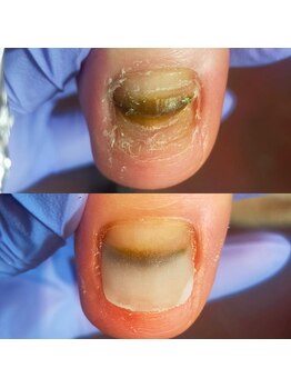 キュア(Cure.)/カラーを楽しむ陥入爪ケア