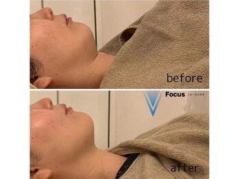 ユミ 町田鶴川店/フェイスライン 引き締め