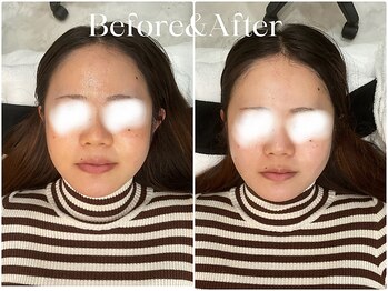 トウキョウビューティーラボ(TOKYO BEAUTY LABO.)/スノーピールBefore&After