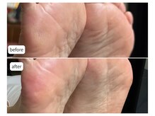 カシェット(Cachette)/40代女性◎足裏角質ケア90分